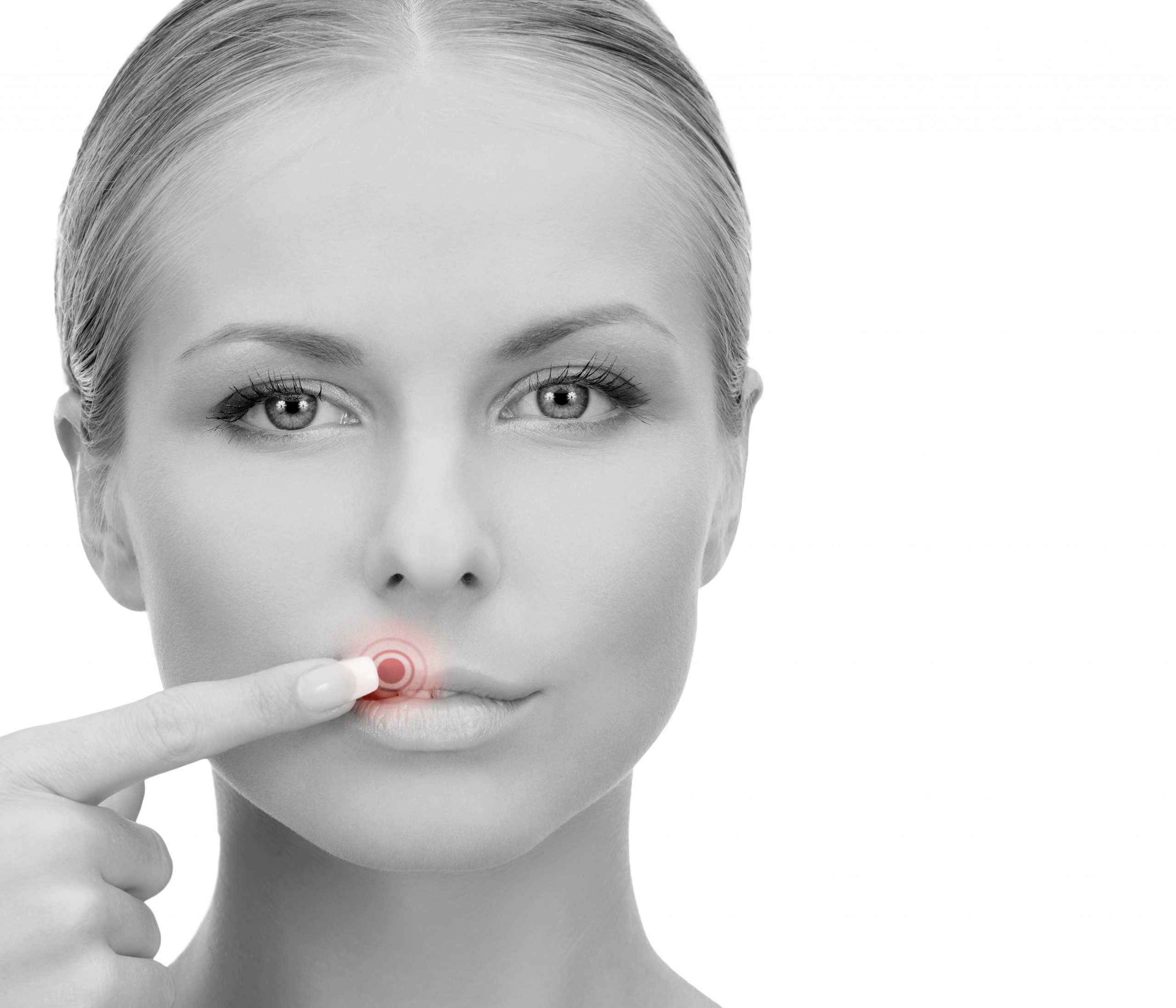 Treating Cold Sores Naturally